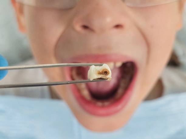 Best Urgent Care for Lost Fillings or Crowns in Remgton, IN
